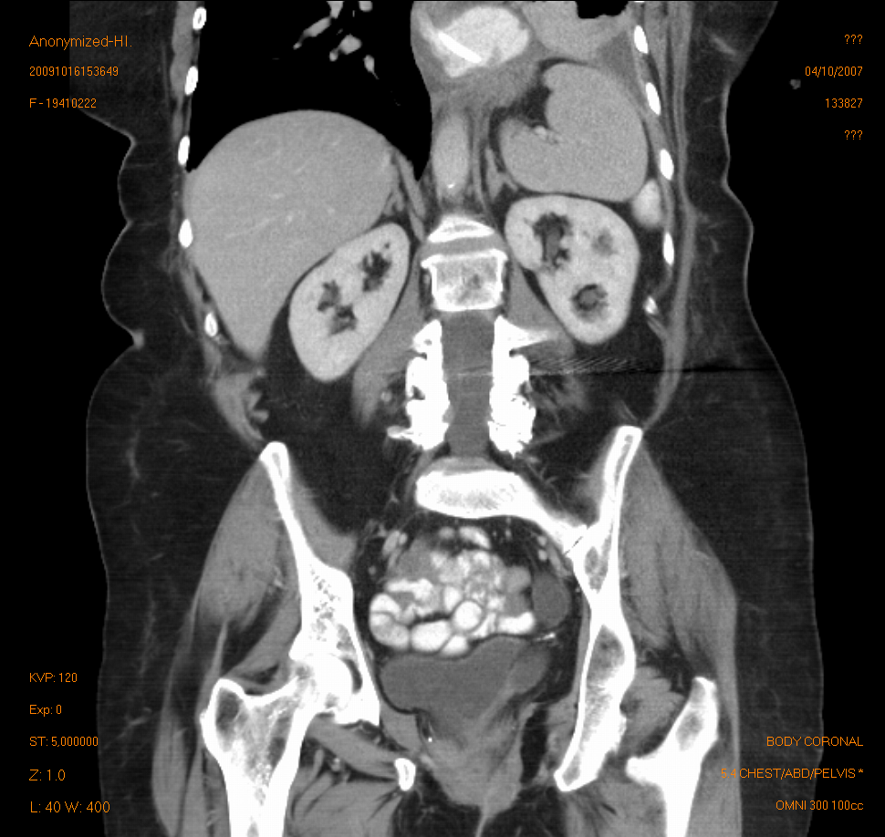 MRI